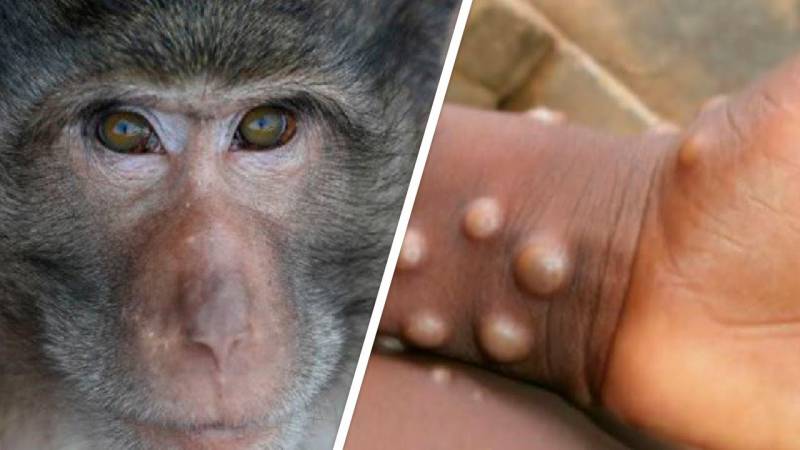 ВОЗ объявила о начале мировой пандемии оспы обезьян, правда или нет